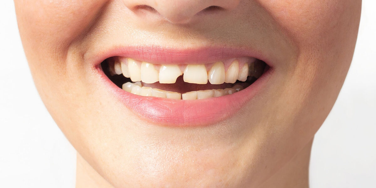 Repairing a Broken Tooth Repairing a Broken Tooth