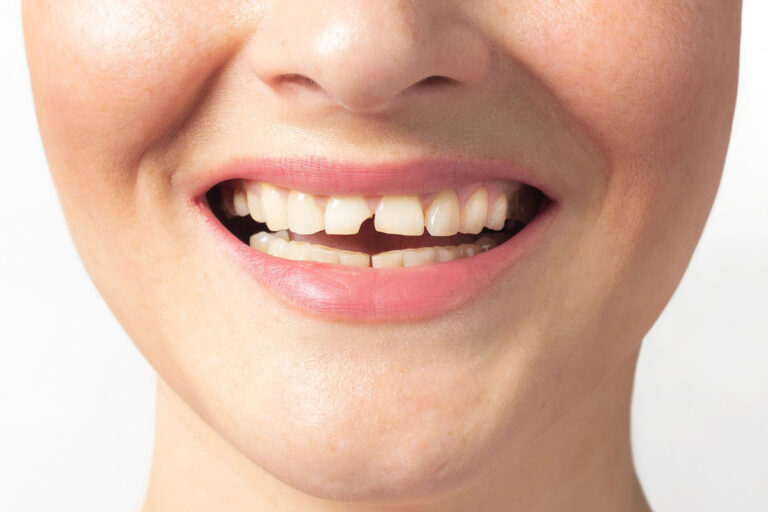 Repairing a Broken Tooth