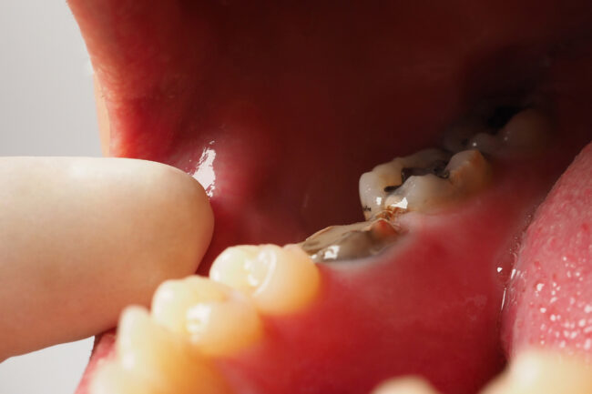 How Holistic Dentists Evaluate Cavitations Differently How Holistic Dentists Evaluate Cavitations Differently