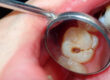 How Holistic Dentists Look at the Real Causes of Recurrent Tooth Decay
