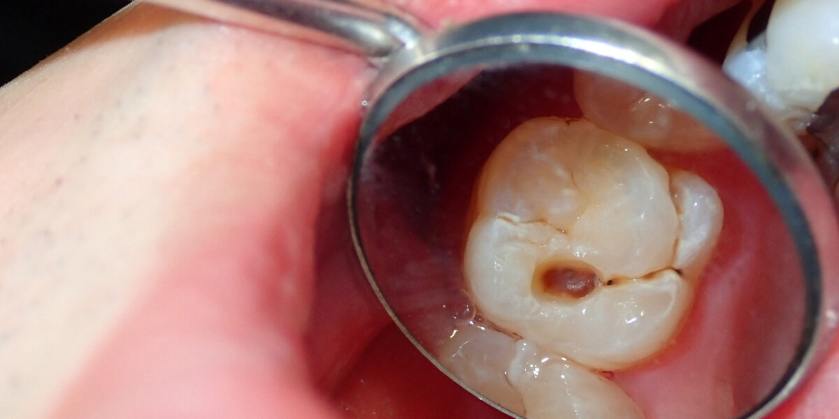 How Holistic Dentists Look at the Real Causes of Recurrent Tooth Decay