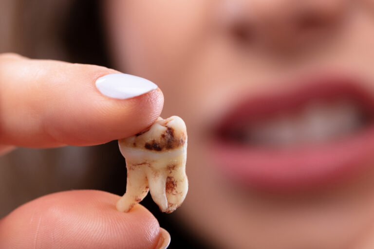 Try to Save a Tooth Naturally Try to Save a Tooth Naturally