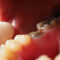 What Your Dentist Should Evaluate Before Treating a New Cavity