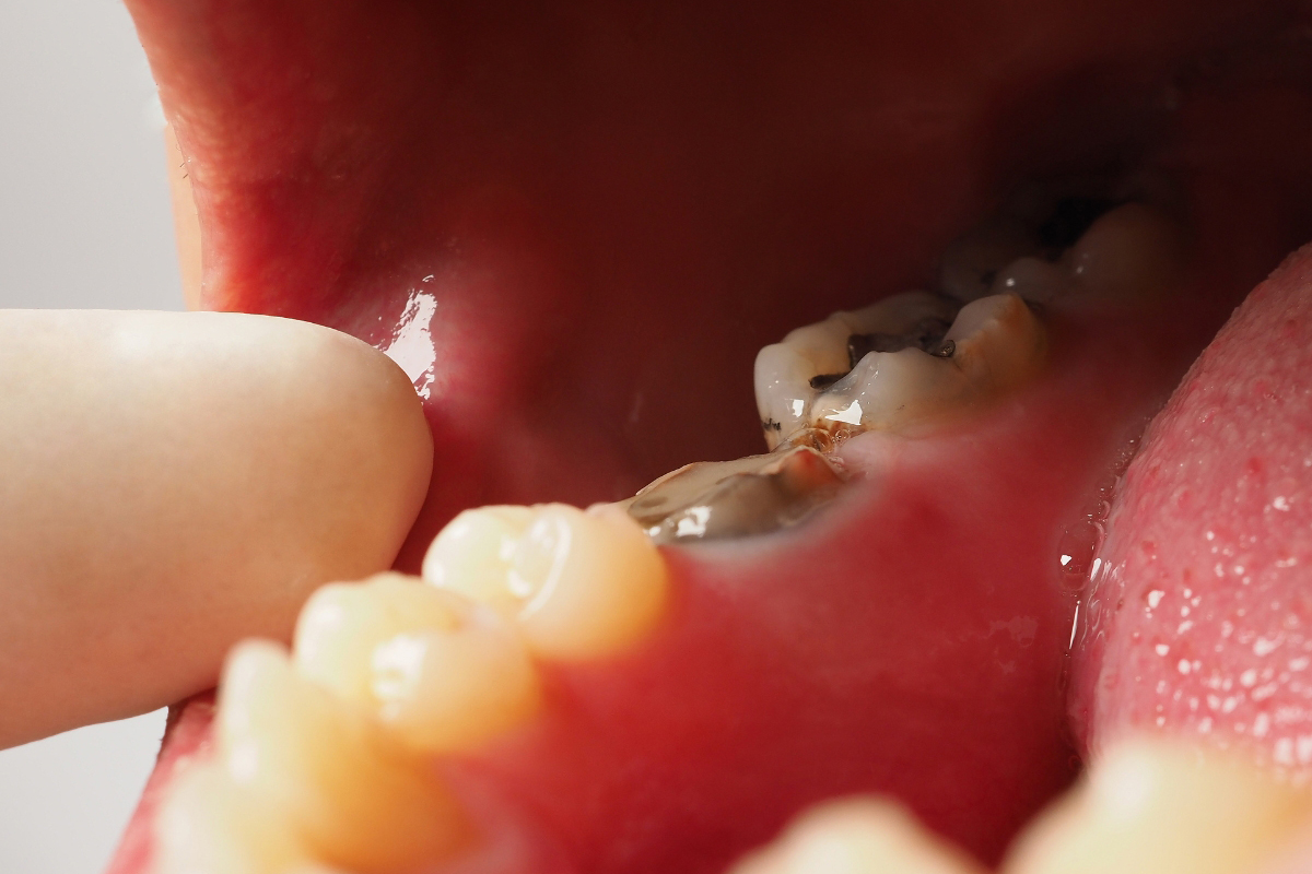 What Your Dentist Should Evaluate Before Treating a New Cavity What Your Dentist Should Evaluate Before Treating a New Cavity