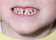 What Holistic Dentists Look for Before Filling a Child’s Tooth