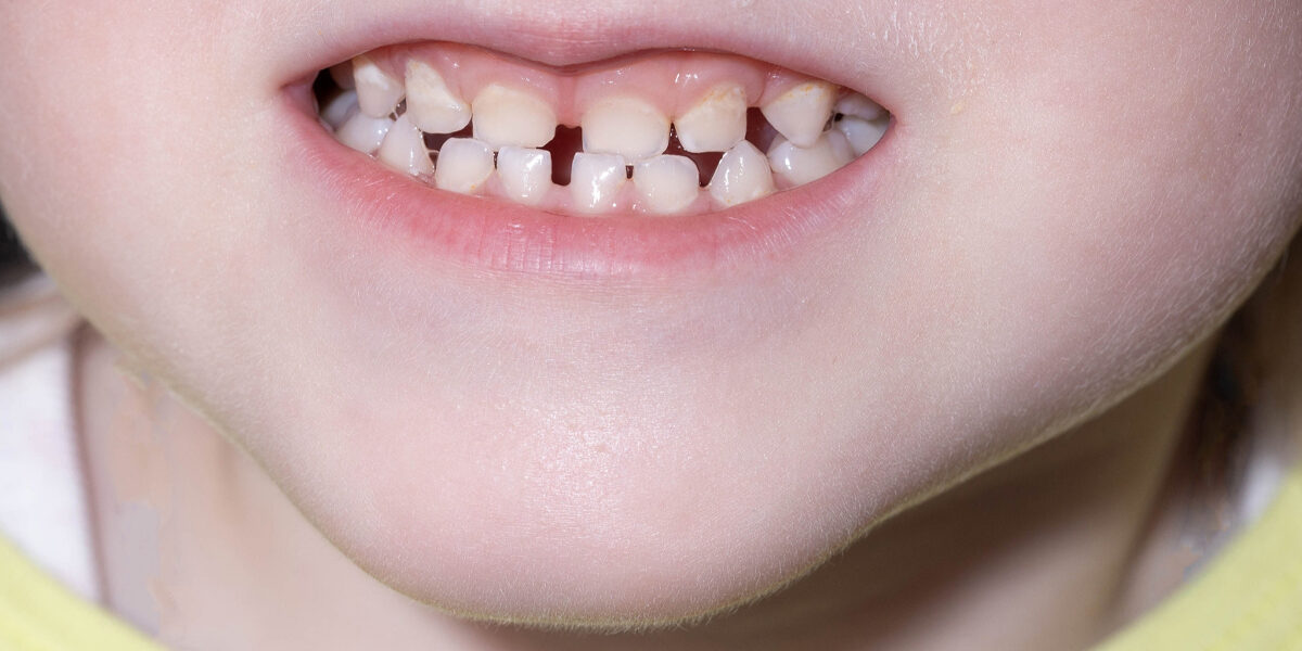 What Holistic Dentists Look for Before Filling a Child’s Tooth