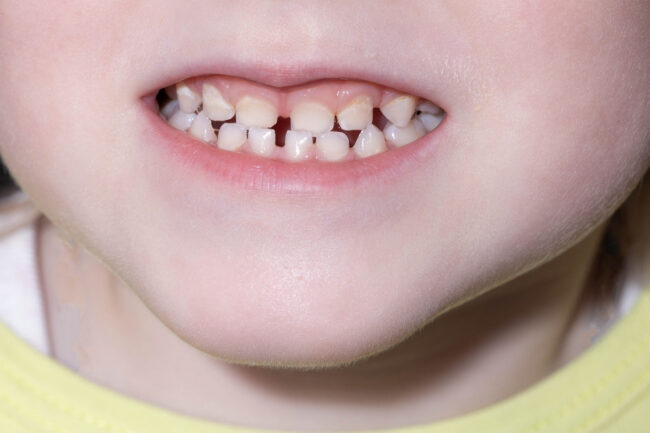 What Holistic Dentists Look for Before Filling a Child’s Tooth