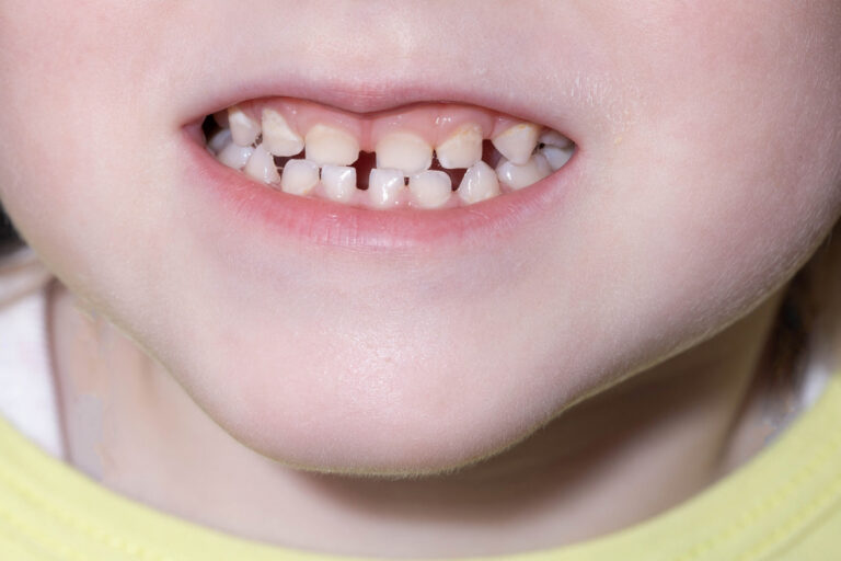 What Holistic Dentists Look for Before Filling a Child’s Tooth What Holistic Dentists Look for Before Filling a Child’s Tooth