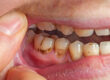 When a Root Canal May Not Be the Only Choice