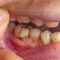 When a Root Canal May Not Be the Only Choice