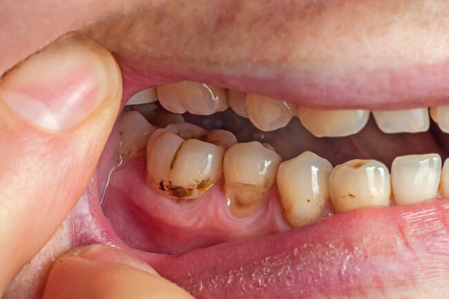 When a Root Canal May Not Be the Only Choice