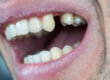 try to save a tooth naturally