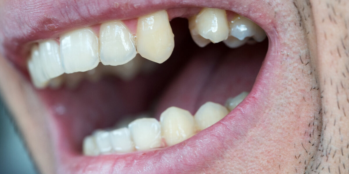 try to save a tooth naturally try to save a tooth naturally