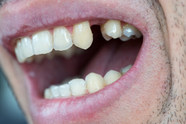 try to save a tooth naturally try to save a tooth naturally