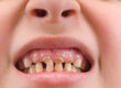 When a Child’s Cavity Can Be Treated Conservatively