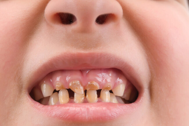 When a Child’s Cavity Can Be Treated Conservatively