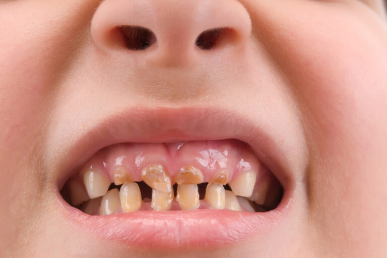 When a Child’s Cavity Can Be Treated Conservatively When a Child’s Cavity Can Be Treated Conservatively