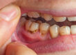 Why Biocompatible Materials Matter in Cavity and Tooth Repair