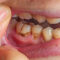 Why Biocompatible Materials Matter in Cavity and Tooth Repair