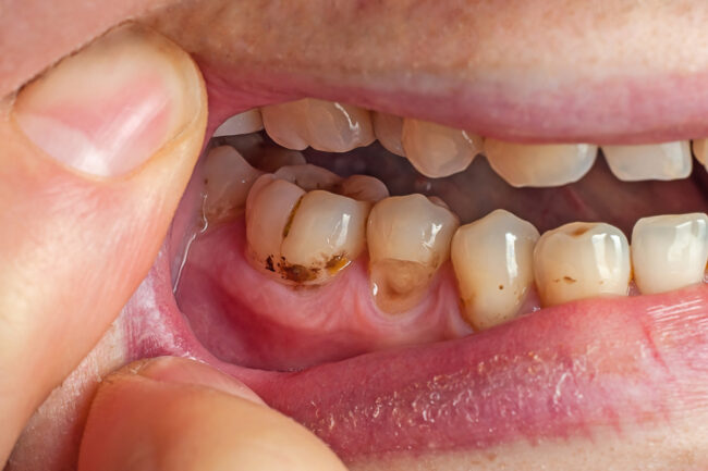 Why Biocompatible Materials Matter in Cavity and Tooth Repair Why Biocompatible Materials Matter in Cavity and Tooth Repair