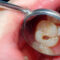What Holistic Dentistry Looks for Before Recommending Drilling