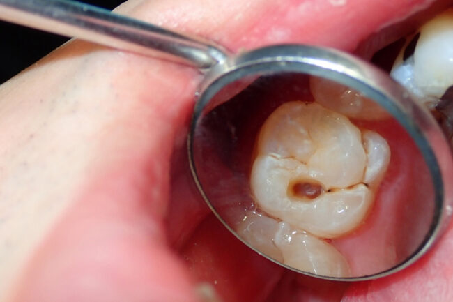 What Holistic Dentistry Looks for Before Recommending Drilling What Holistic Dentistry Looks for Before Recommending Drilling